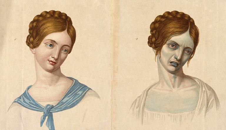 portrait of a woman before and after tuberculosis